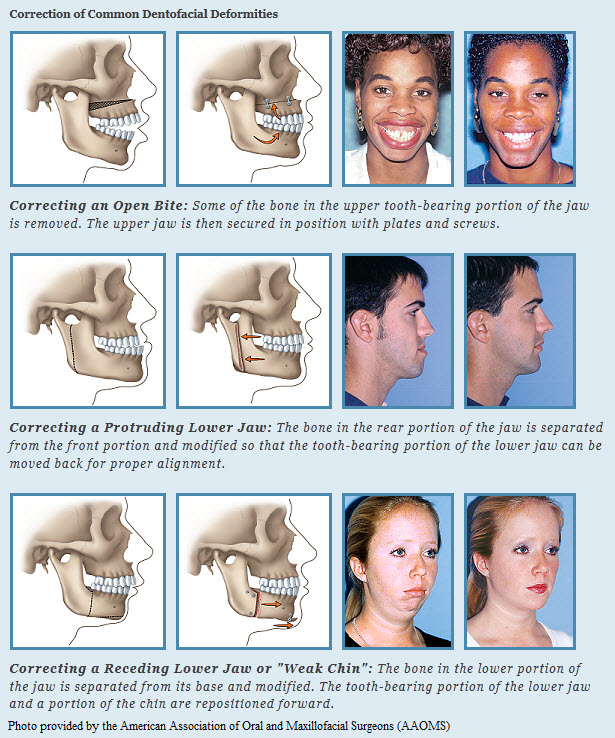 Surgical Orthodontics Flemington NJ Cedarbaum Orthodontics